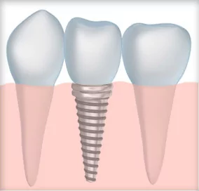 Tooth implant diagram shows how implant dentistry is performed at Blaisdell Family Dentistry near Eagle and Meridian, ID.